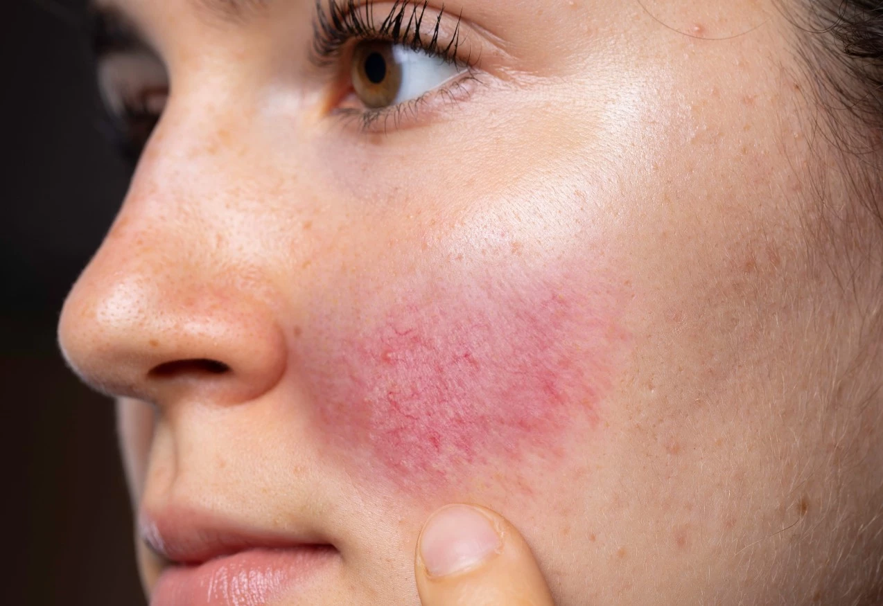 Rozaceea: Ghid Complet pentru Înțelegere și Îngrijire