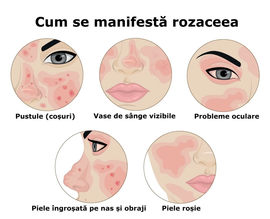 Rozaceea: Ghid Complet pentru Înțelegere și Îngrijire