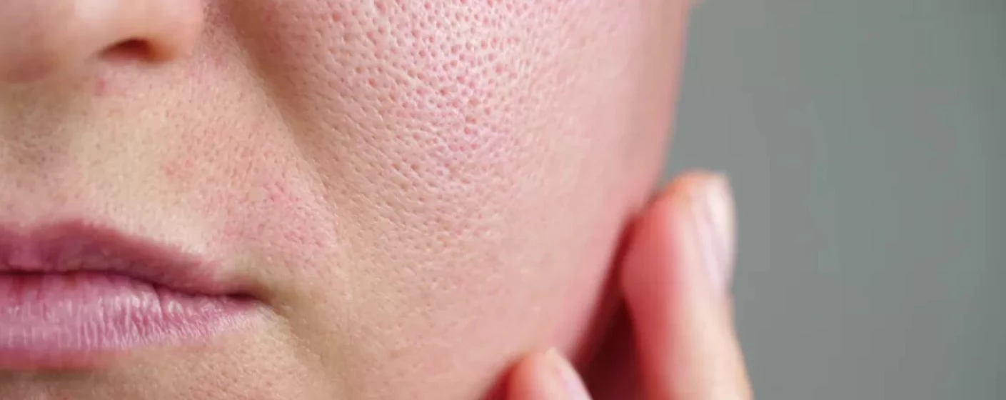 Ghid Complet pentru Tenul cu Pori Dilatați și Exces de Sebum