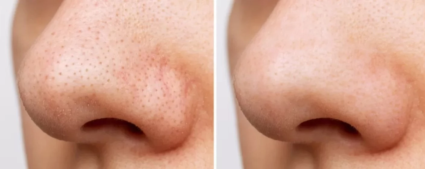 Ghid Complet pentru Tenul cu Pori Dilatați și Exces de Sebum